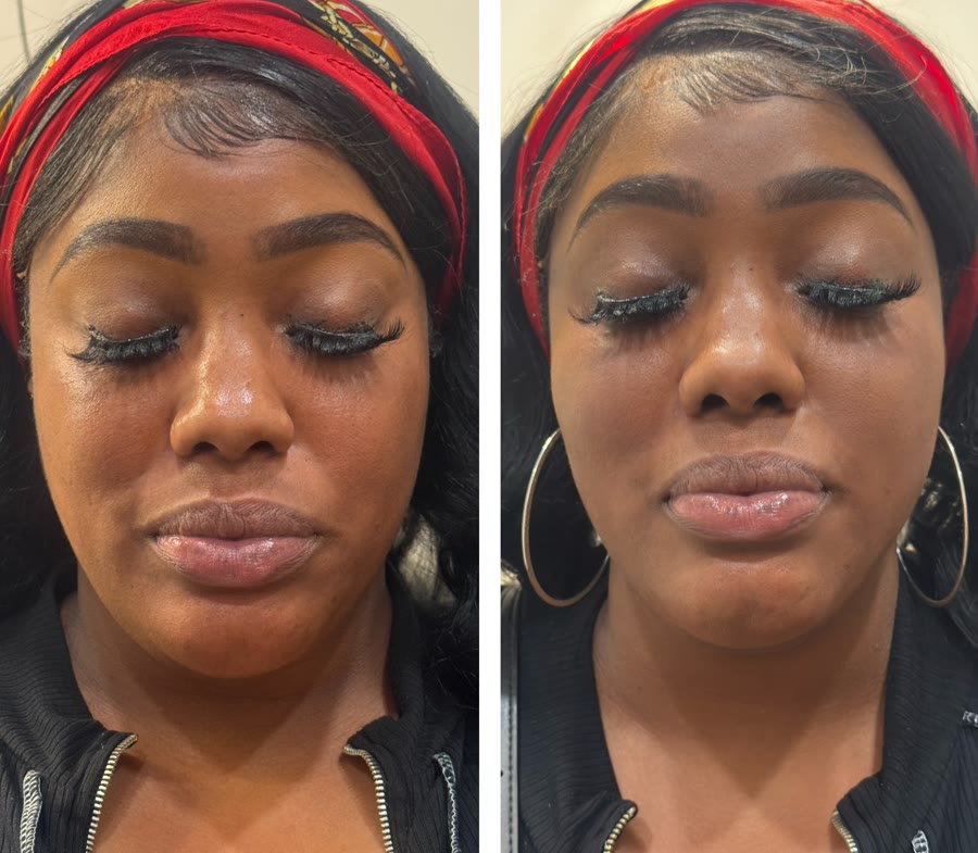 Facial balancing and glow — before and after