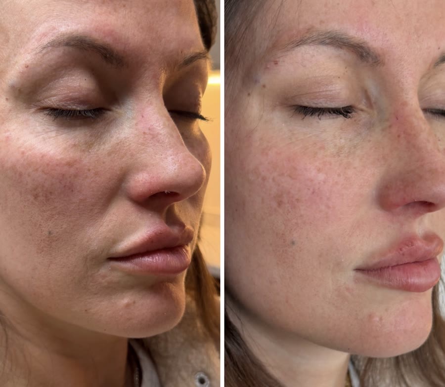Skin and lip refresh — before and after