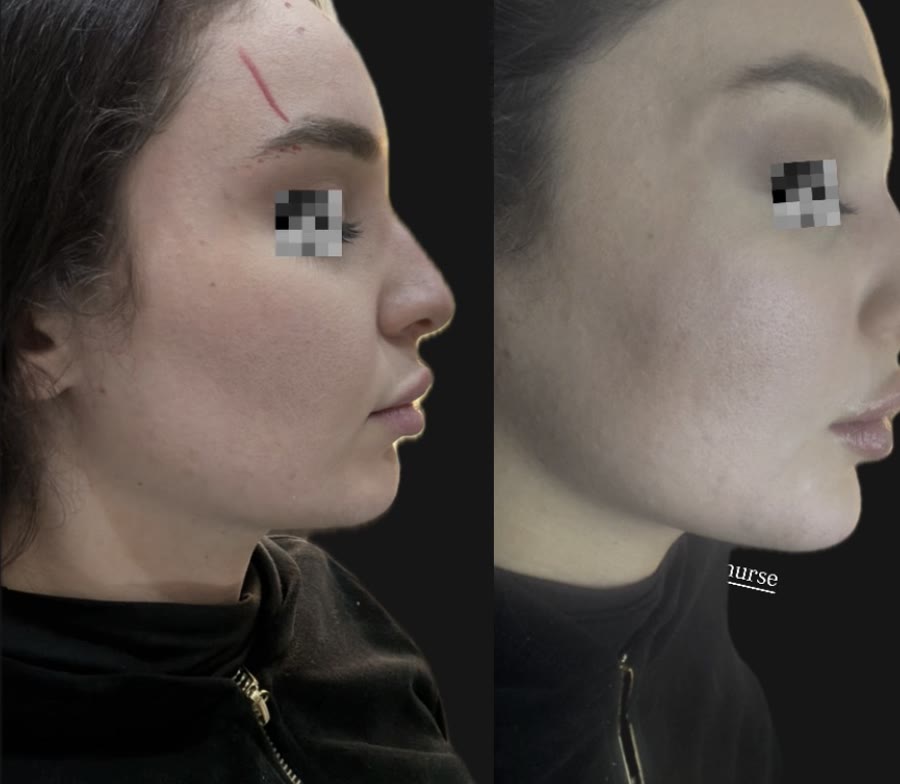 Jawline and chin definition — before and after