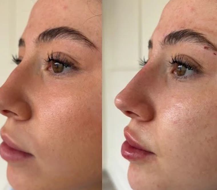 Liquid rhinoplasty — before and after