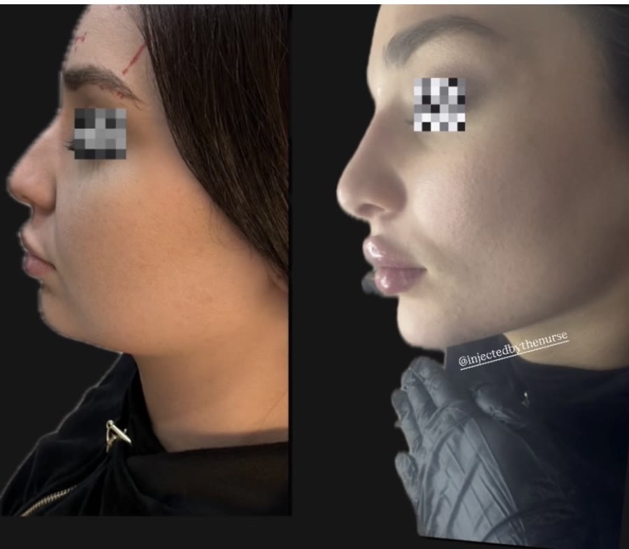 Profile balancing with filler — before and after