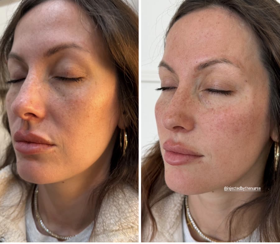 Skin rejuvenation — before and after